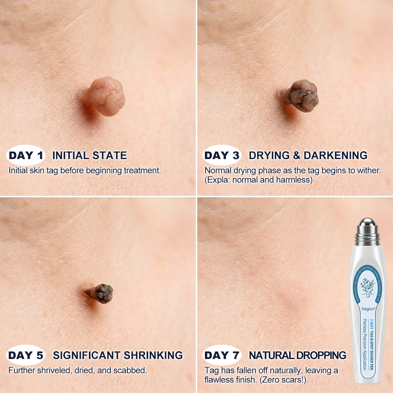 Yagoo® 7-𝐷𝑎𝑦 𝗧𝐚𝐠 & 𝗦𝗽𝐨𝐭 𝐄𝐫𝒂𝒔𝒆𝒓✅🎉(Zero Pain, Zero 𝐒𝐜𝐚𝒓𝒔 Rollerball)