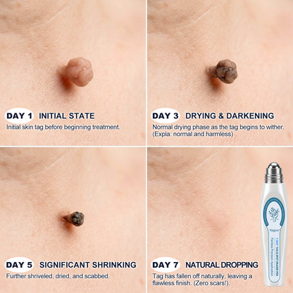 Yagoo® 7-𝐷𝑎𝑦 𝗧𝐚𝐠 & 𝗦𝗽𝐨𝐭 𝐄𝐫𝒂𝒔𝒆𝒓✅🎉(Zero Pain, Zero 𝐒𝐜𝐚𝒓𝒔 Rollerball)