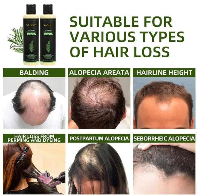 🌱 LAST DAY 50% OFF-Yagoo® Rosemary Hydrolyzed Shampoo , Unlock the Secret to Thicker, Healthier-Looking Hair